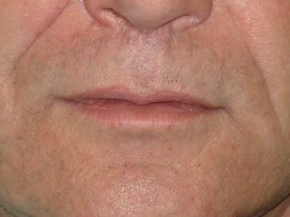 Lip Lift Before & After Patient #1288