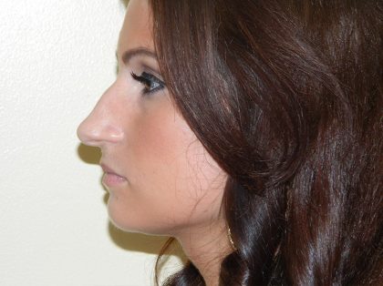 Rhinoplasty Before & After Patient #3067
