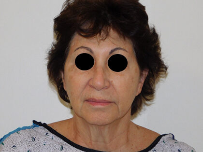 Before Photo of Traditional Facelift in Philadelphia
