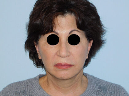 After Photo of Traditional Facelift in Philadelphia