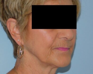 Before Photo of Fraxel Laser Resurfacing in Philadelphia