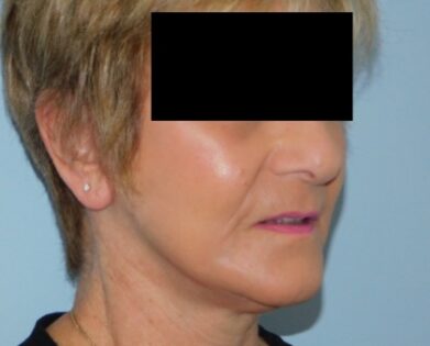 After Photo of Fraxel Laser Resurfacing in Philadelphia