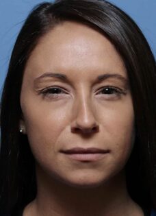 After Photo of BOTOX® in Philadelphia
