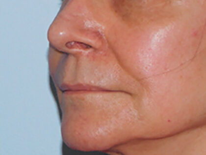 Before Photo of Lip Lift in Philadelphia
