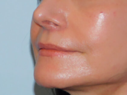 After Photo of Lip Lift in Philadelphia