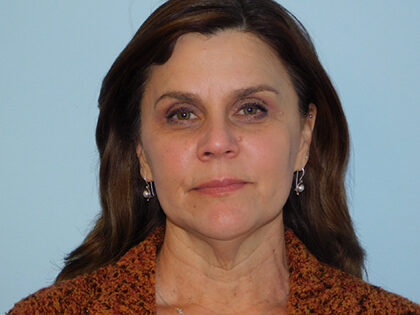 Before Photo of Traditional Facelift in Philadelphia