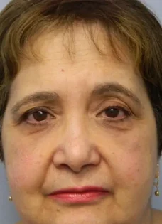 Before Photo of Blepharoplasty in Philadelphia