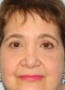 After Photo of Blepharoplasty in Philadelphia