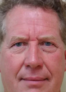 Before Photo of Blepharoplasty in Philadelphia