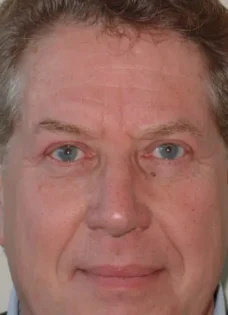 After Photo of Blepharoplasty in Philadelphia
