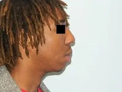 Before Photo of Chin Augmentation in Philadelphia