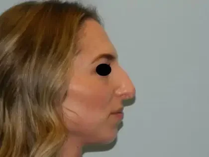 Before Photo of Chin Augmentation in Philadelphia