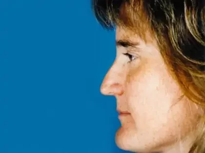 Before Photo of Chin Reduction in Philadelphia