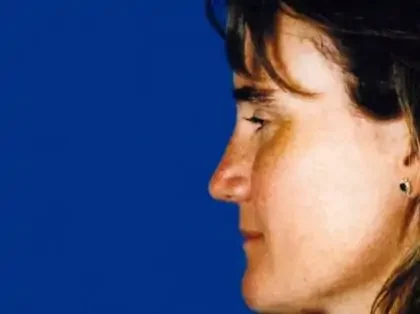 After Photo of Chin Reduction in Philadelphia