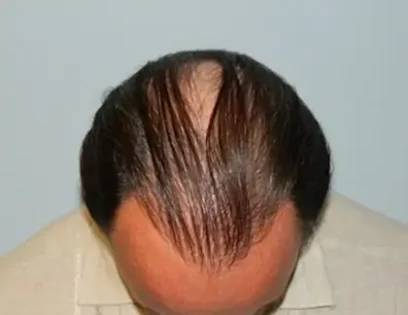 Before Photo of Hair Transplant Smartgraft in Philadelphia