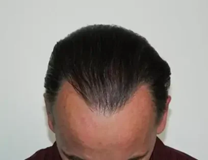 After Photo of Hair Transplant Smartgraft in Philadelphia
