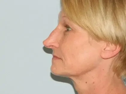 Before Photo of Injectable Fillers in Philadelphia