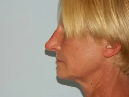 After Photo of Injectable Fillers in Philadelphia