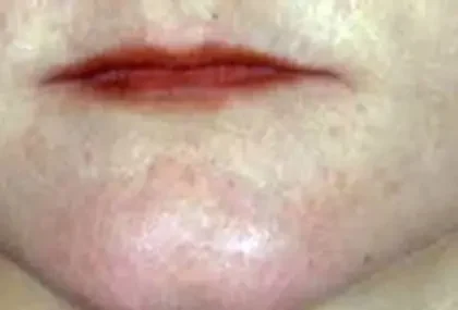 Before Photo of Lip Lift in Philadelphia