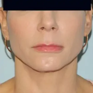 Before Photo of Lip Lift in Philadelphia