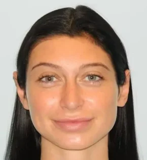 After Photo of Otoplasty in Philadelphia