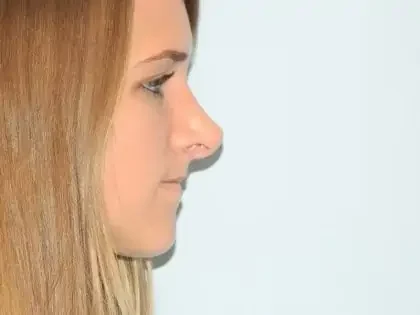 Before Photo of Revision Rhinoplasty in Philadelphia