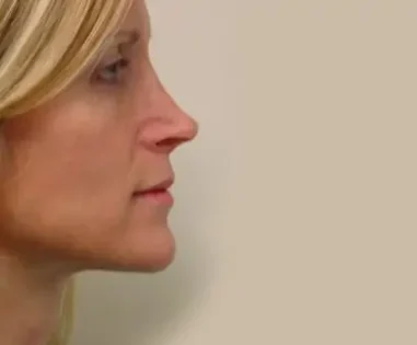 Before Photo of Revision Rhinoplasty in Philadelphia