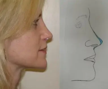 After Photo of Revision Rhinoplasty in Philadelphia