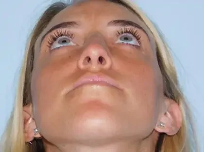 Before Photo of Rhinoplasty in Philadelphia