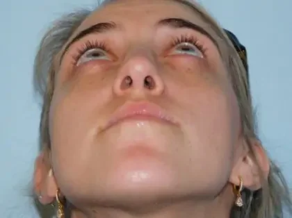 After Photo of Rhinoplasty in Philadelphia