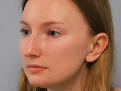 Before Photo of Rhinoplasty in Philadelphia