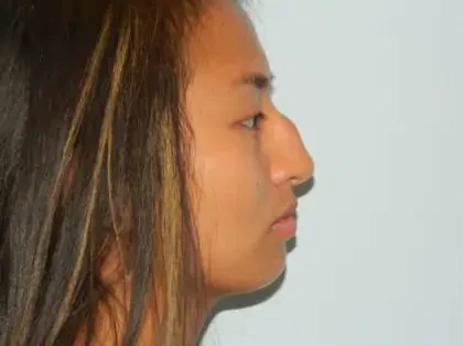 Before Photo of Rhinoplasty in Philadelphia