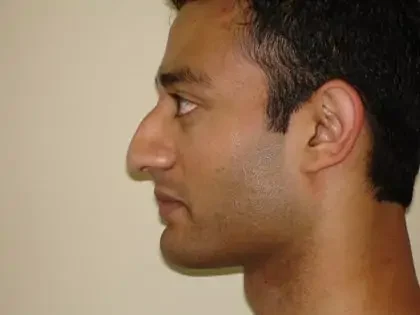 Before Photo of Rhinoplasty in Philadelphia