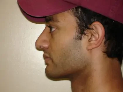 After Photo of Rhinoplasty in Philadelphia