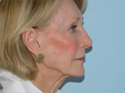 Before Photo of Traditional Facelift in Philadelphia