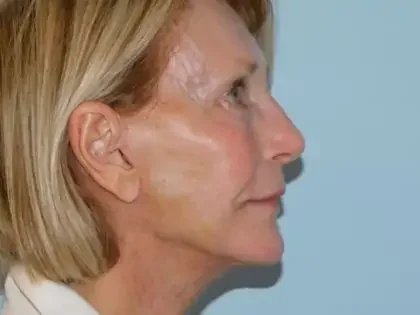 After Photo of Traditional Facelift in Philadelphia