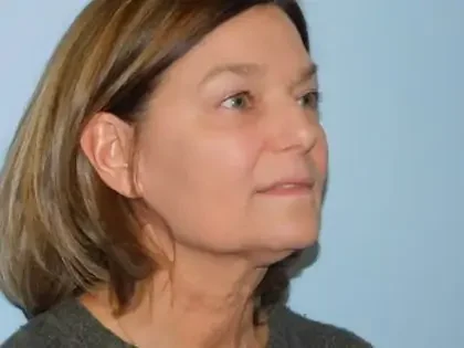 Before Photo of Traditional Facelift in Philadelphia