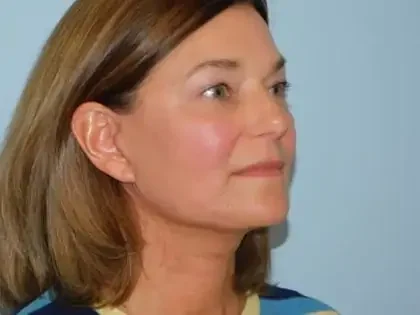 After Photo of Traditional Facelift in Philadelphia