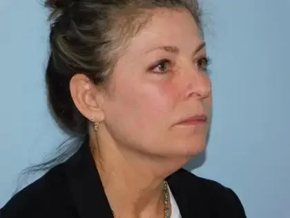 Before Photo of Traditional Facelift in Philadelphia