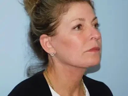After Photo of Traditional Facelift in Philadelphia