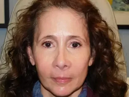 Before Photo of Ultherapy in Philadelphia