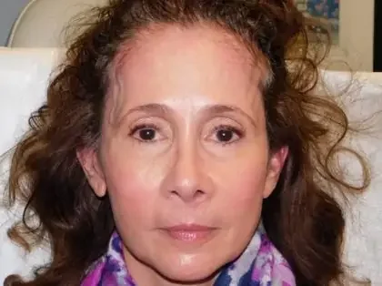 After Photo of Ultherapy in Philadelphia