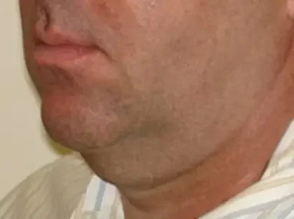 Before Photo of Ultherapy in Philadelphia