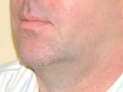 After Photo of Ultherapy in Philadelphia