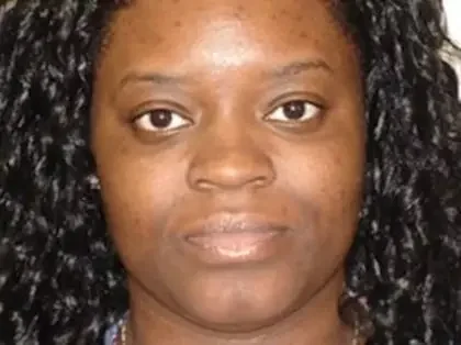 After Photo of Ultherapy in Philadelphia
