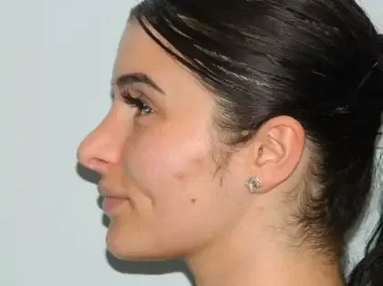 Before Photo of Revision Rhinoplasty in Philadelphia