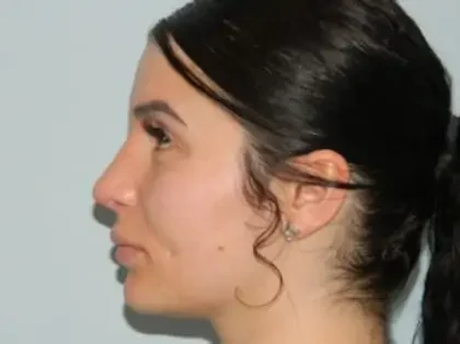 After Photo of Revision Rhinoplasty in Philadelphia