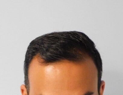 Before Photo of Hair Transplant Smartgraft in Philadelphia