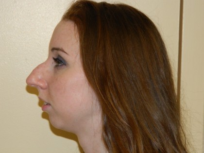 Chin Augmentation Before & After Patient #1084