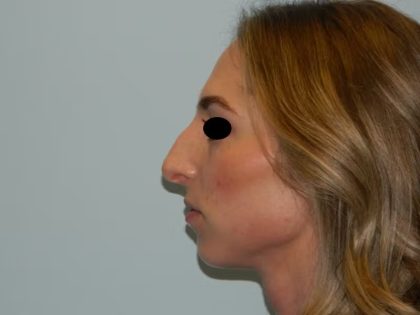 Chin Augmentation Before & After Patient #1231